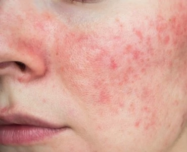 Rosacea (R)